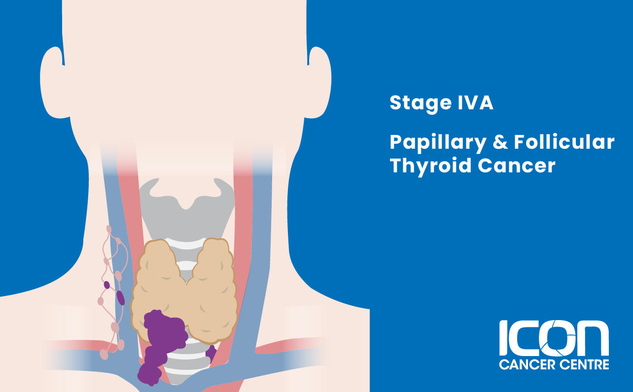 Stage IVA papillary and follicular thyroid cancer illustration