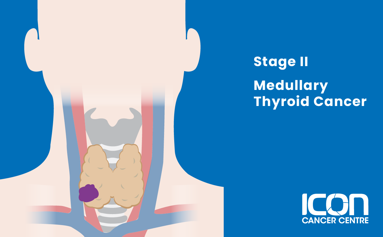 Stage II medullary thyroid cancer illustration