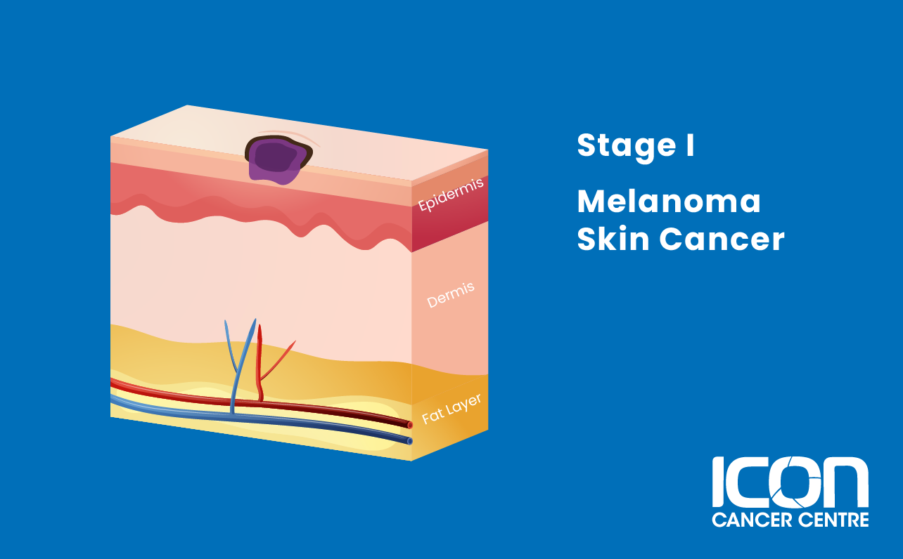 Stage I melanoma illustration