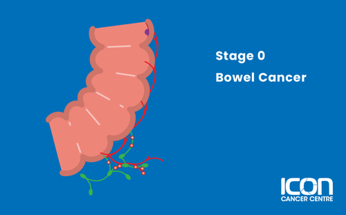 Illustration of Bowel Cancer Stage