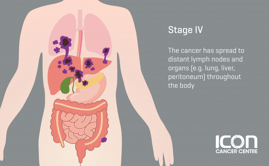 Colorectal Cancer Signs And Symtomps Icon Centre Singapore