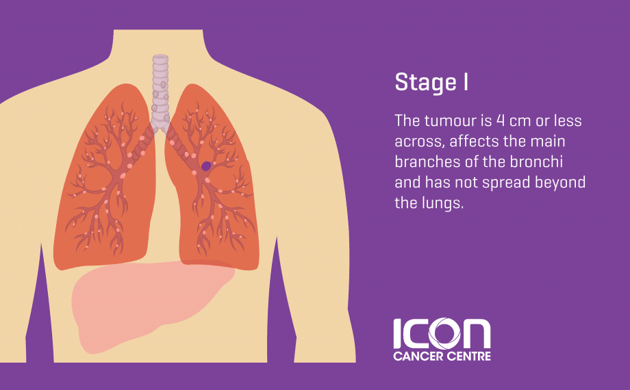 Stage 1 Of Lung Cancer
