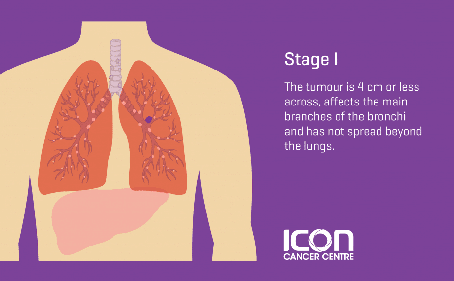 Lung Cancer Types And Stages Icon Cancer Centre Singapore