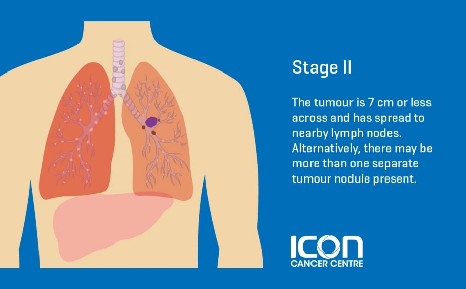 Lung Cancer Types & Stages | Icon Cancer Centre Singapore