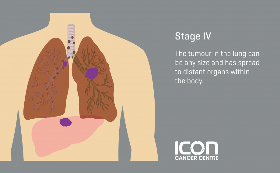 Lung Cancer Types And Stages Icon Cancer Centre Singapore