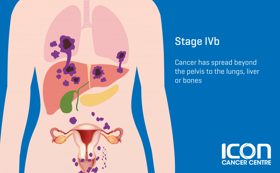 cervical-cancer-icon-cancer-centre-singapore