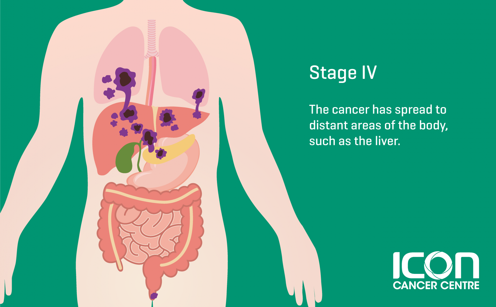 Anal Cancer — Icon Cancer Centre Singapore 4446