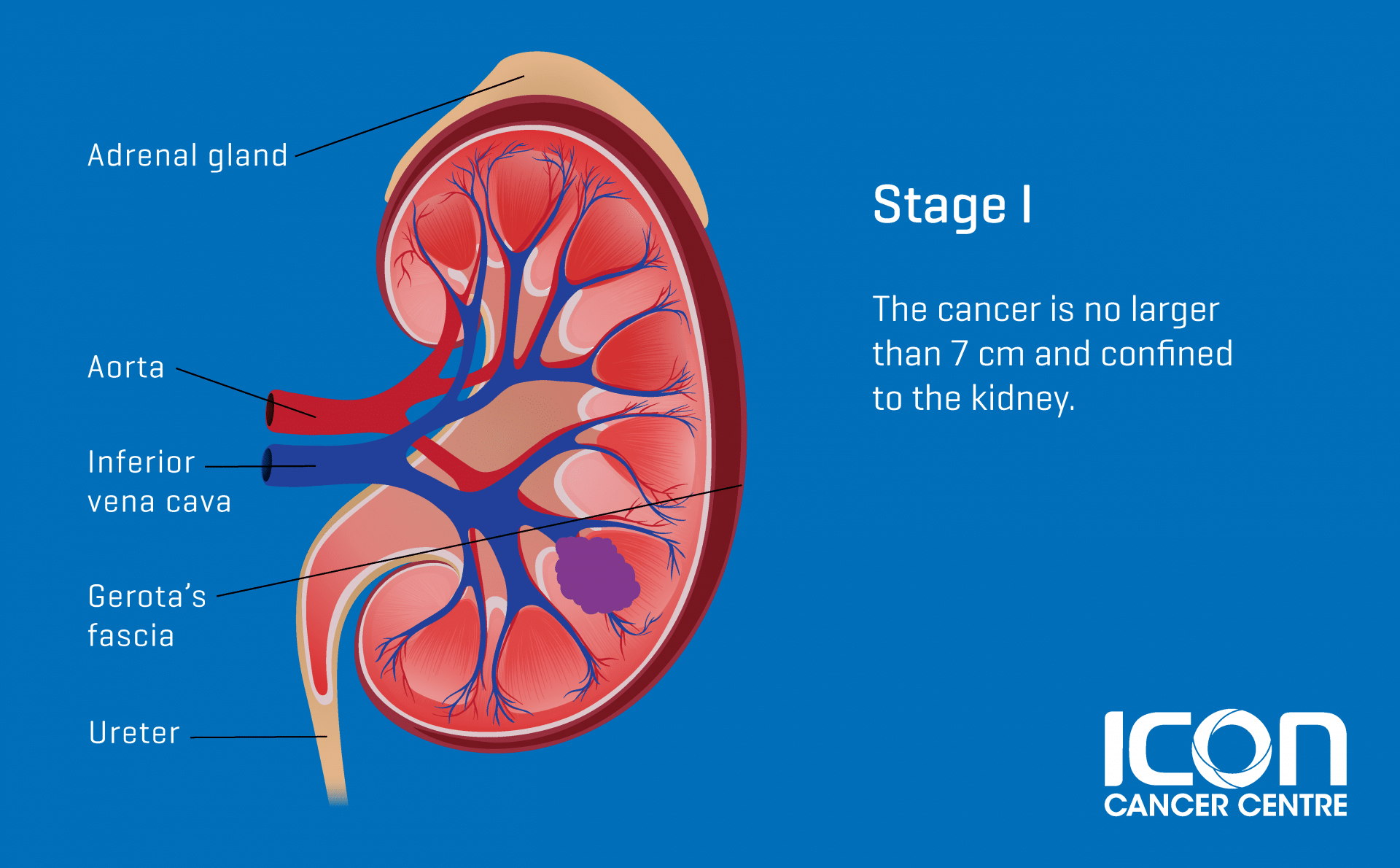 kidney cancer essay