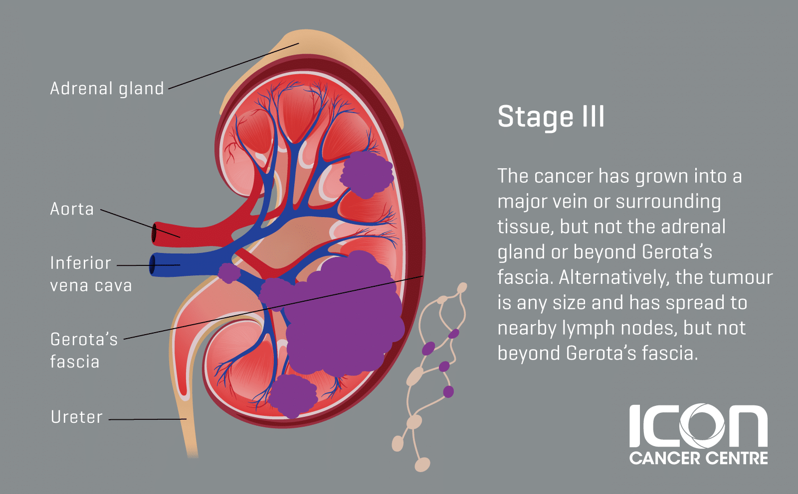 Kidney Cancer — Icon Cancer Centre Singapore