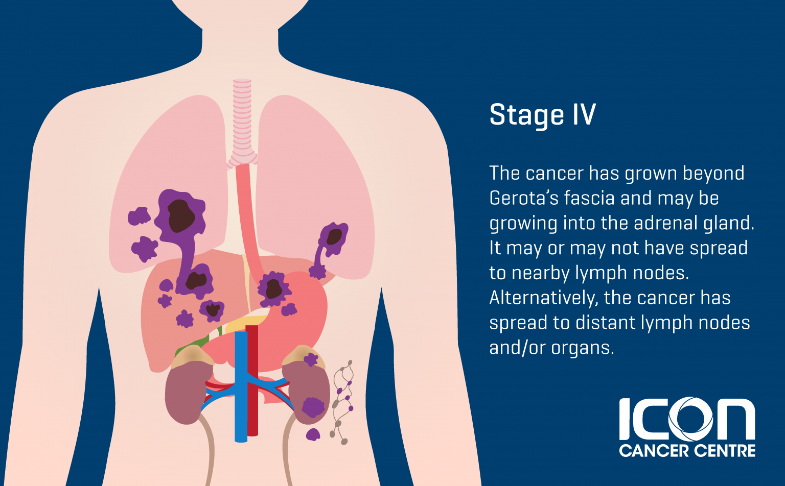 Kidney Cancer — Icon Cancer Centre Singapore