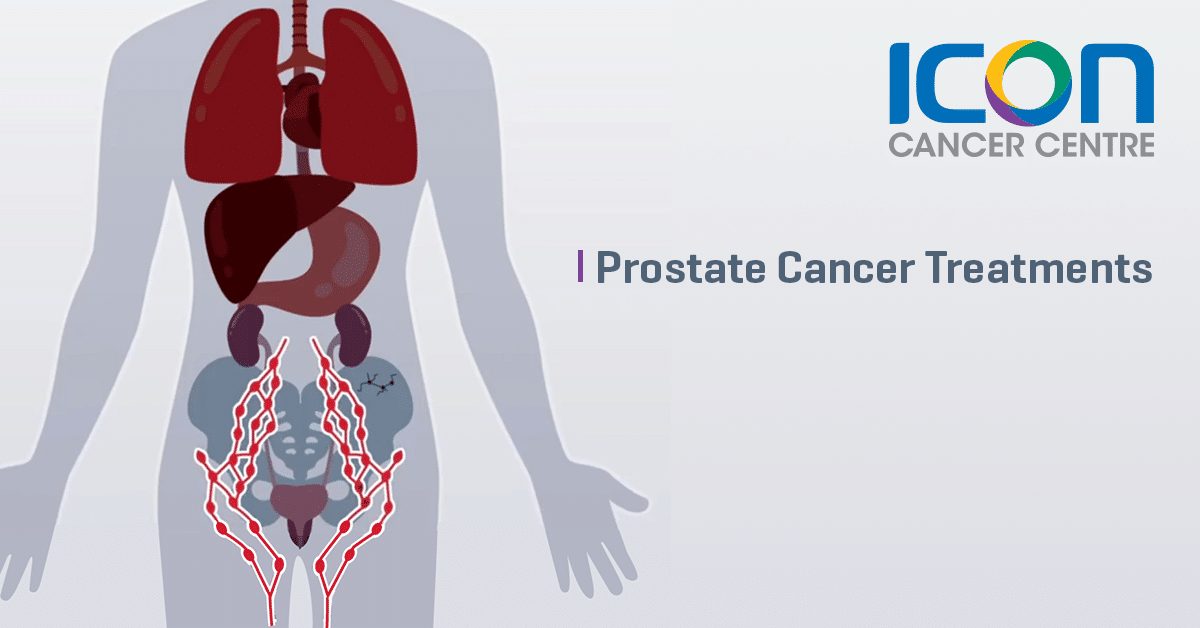 Metastatic Prostate Cancer And Its Treatment — Icon Cancer Centre Singapore 5275